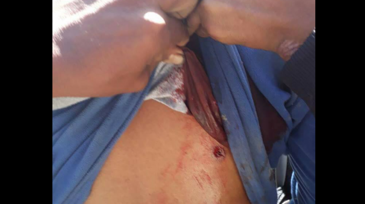 Un cocalero herido en el enfrentamiento con los policías: Foto: Yungueños por el mundo